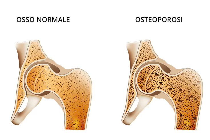 osteoporosi