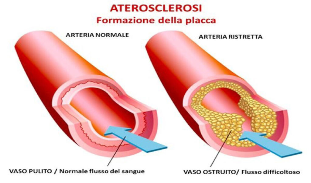 colesterolo-aterosclerosi